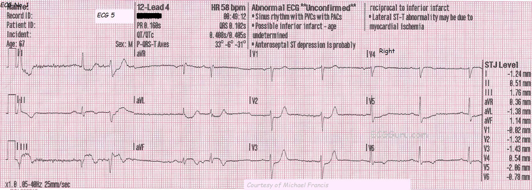 Posterior Wall Mi 12 Lead Ecg